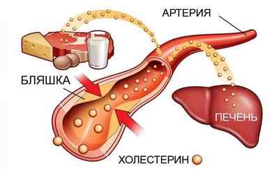 Атеросклероз судин: причини, симптоми, лікування