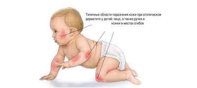Атопічний дерматит у дітей: лікування народними засобами