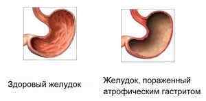 Атрофічний гастрит шлунка: що це таке, причини виникнення, симптоми і лікування, код за МКБ 10 відгуки хворих, фото, прогноз