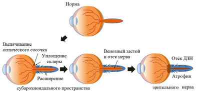 Атрофія зорового нерва (часткова, спадна): лікування, симптоми ураження