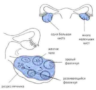 Багатокамерна кіста яєчника: види, симптоми і лікування