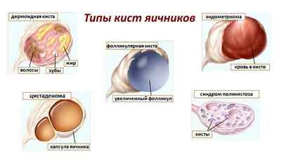 Багатокамерна кіста яєчника: види, симптоми і лікування