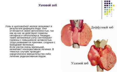 Багатовузловий зоб щитовидної залози: симптоми і лікування
