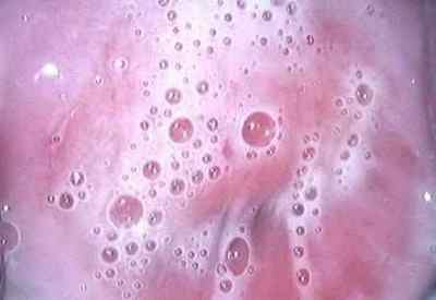 Бактеріальний вагіноз: лікування, симптоми, причини (фото)