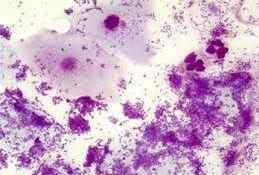 Бактеріальний вульвовагініт: причини, симптоми і лікування