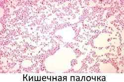 Бактерії групи кишкової палички: види і особливості збудника