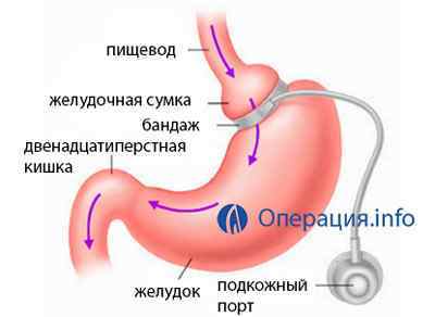 Бандажування шлунка: проведення операції та наслідки