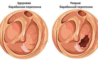 Баротравма вуха: симптоми і лікування