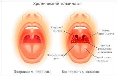 Білі грудочки в горлі з неприємним запахом: причини, лікування