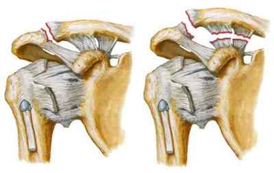 Біль у ключиці (справа або зліва): причини і лікування