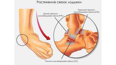 Біль в гомілковостопному суглобі: причини і лікування болю в ступні біля пальців при ходьбі, сухожилля на нозі і верх стопи | Ревматолог