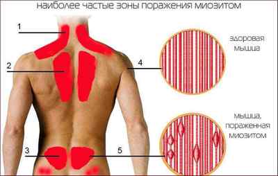 Біль в грудях зліва при вдиху: можливі причини, лікування