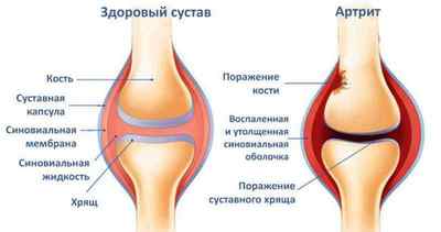 Біль в колінах при ходьбі і бігу: мазі для суглобів, причини і лікування болю в при ходьбі по сходах, народні засоби | Ревматолог