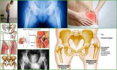 Біль в тазостегновому суглобі віддає в ногу і сідницю - причини і лікування