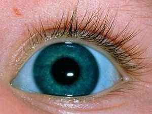 Блакитні склери у дитини, причини синдрому на білках очей
