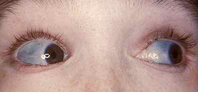 Блакитні склери у дитини, причини синдрому на білках очей