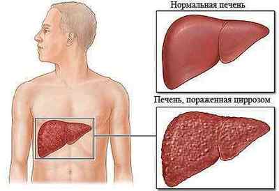 Біліарний цироз печінки: симптоми і лікування, причини, діагностика