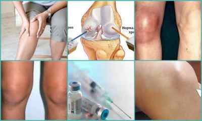 Блокада колінного суглоба: як проводиться процедура, препарати, ціна, відгуки