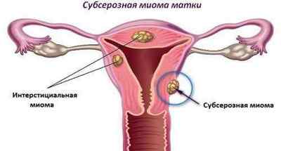 Болі при міомі матки: причини, способи лікування