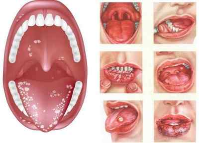 Болить горло і корінь язика при ковтанні: причини, лікування
