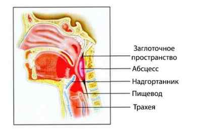 Болить горло з одного боку: причини болю в горлі справа або зліва
