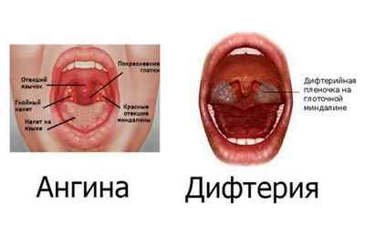 Болить горло з одного боку: причини болю в горлі справа або зліва