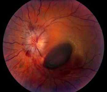 Болить очей зсередини: причини болю всередині очного яблука при натисканні, що робити