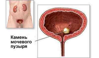 Болить сечовий міхур у чоловіків та жінок: лікування, симптоми