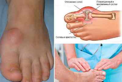 Болить суглоб великого пальця на нозі: причини і лікування болю великих пальців біля нігтя в суглобі, болять кісточки на ногах | Ревматолог