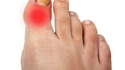 Болить суглоб великого пальця на нозі: причини і лікування болю великих пальців біля нігтя в суглобі, болять кісточки на ногах | Ревматолог
