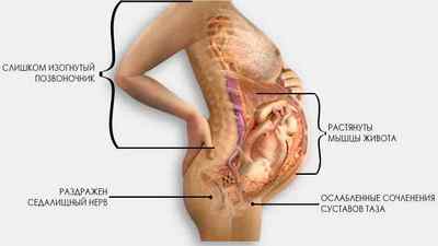 Болить в куприку і вагітність: що робити якщо сильно болить в області куприка після пологів, тягне поперек на ранніх термінах | Ревматолог