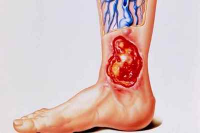Болять ноги при цукровому діабеті: що робити, лікування почервоніння і болю, фото