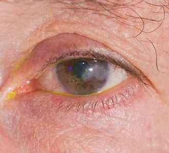 Болять очі: що робити, чому виникає біль в очних яблуках, причини