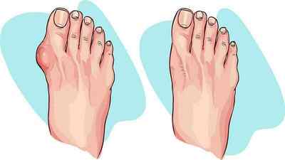 Болять пальці на ногах при ходьбі: причини і лікування великого пальця, тріщини на мізинці, як лікувати печіння і біль при згинанні | Ревматолог