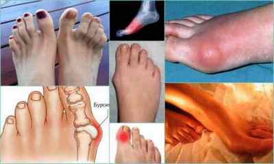 Болять суглоби пальців ніг - причини і лікування