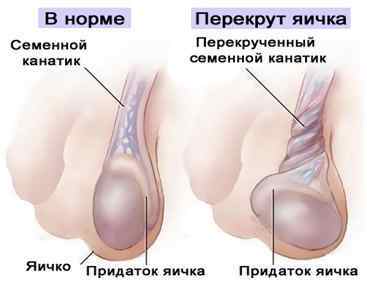 Болять яєчка у чоловіків (ліве або праве): причини і лікування