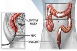 Біопсія кишечника: як проводиться і що показує процедура?