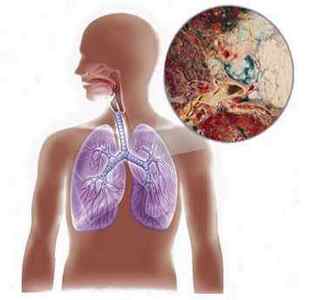 Біопсія легень: показання (при раку, саркоїдозі), хід і результати