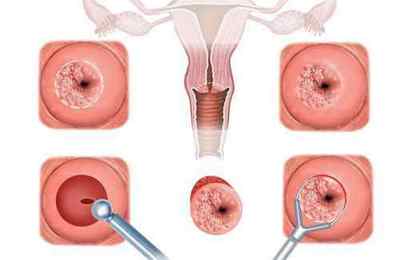Біопсія шийки матки: підготовка, проведення та розшифровка результатів