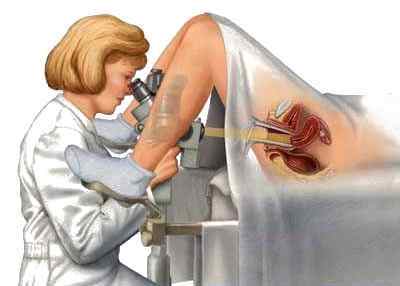 Біопсія шийки матки: як проводять, показання, результати