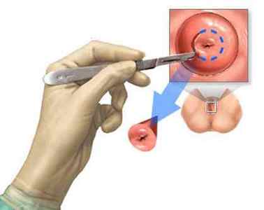 Біопсія шийки матки: як проводять, показання, результати