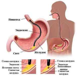 Біопсія шлунка: показання, проведення, результати і розшифровка