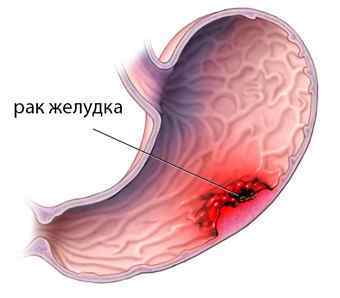 Біопсія шлунка: показання, проведення, результати і розшифровка