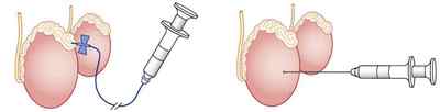 Біопсія яєчка: показання та застосування, хід процедури, результат