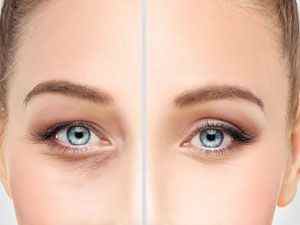 Біоревіталізація очей: відгуки, причини мішків, набряків і синців під очима