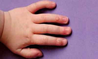 Бородавки у дитини на руках і пальцях: небезпечні наслідки