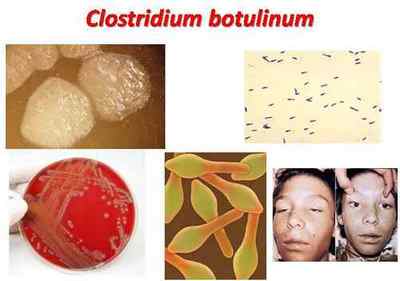 Ботулізм: симптоми, шляхи зараження та лікування хвороби