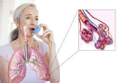 Бронхіальна астма: причини виникнення