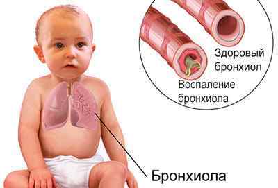 Бронхиолит у дітей: симптоми, ознаки, лікування