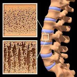 Бісфосфонати для лікування остеопорозу: терапії постменопаузального остеопорозу, назви медичних препаратів | Ревматолог